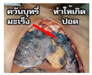 Thailand 2006 Health Effects lung - lung cancer, lived experience, gross, diseased organ